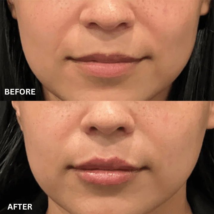 Lip Flip Before and After