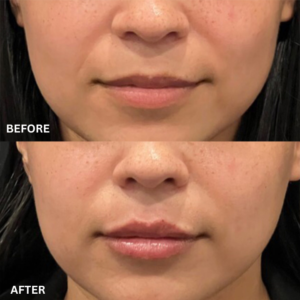 Read more about the article Lip Flip Before and After: Expectations vs Reality