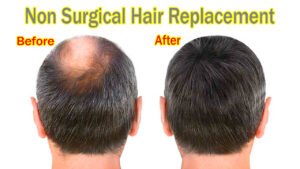 Non Surgical Hair Replacement 