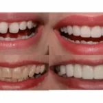 5 Key Differences Between Prep and No-Prep Veneers