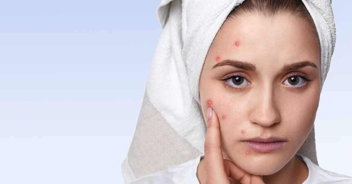 girl has ance on her face skinpres t