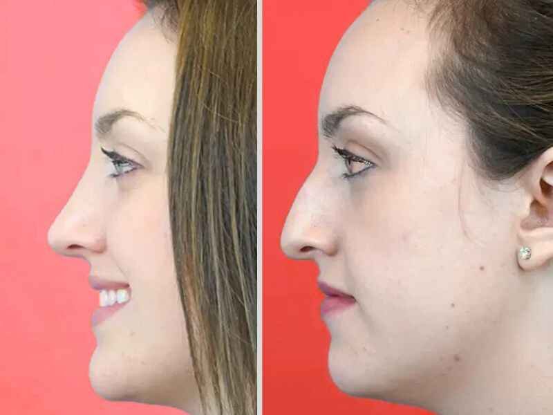 How Much Is a Nose Job? Real Prices, Risks, and Options 5 Before and after nose job showing nose transformation after rhinoplasty, conceptual medical comparison.